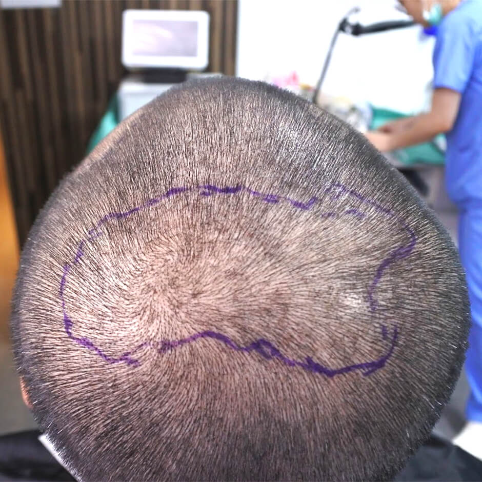 禿頭 植髮  掉髮  雄性禿